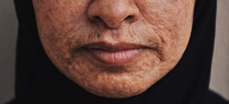 woman's lower face region filled with scars which are one of the ways how does drug abuse affect skin health.