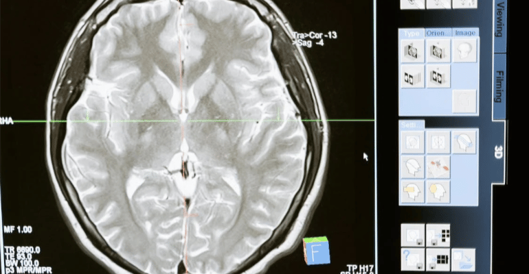 A close-up of a brain scan on a computer screen.