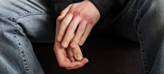 A person with bruised hands.