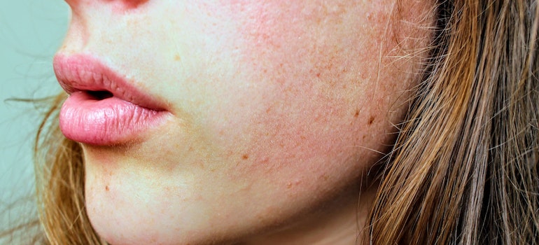 Woman with skin condition because of alcohol abuse.