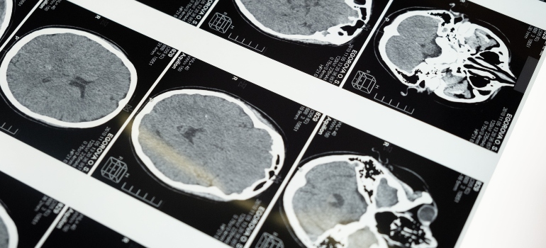 Pictures of a brain scan for a person using TMS for addiction.