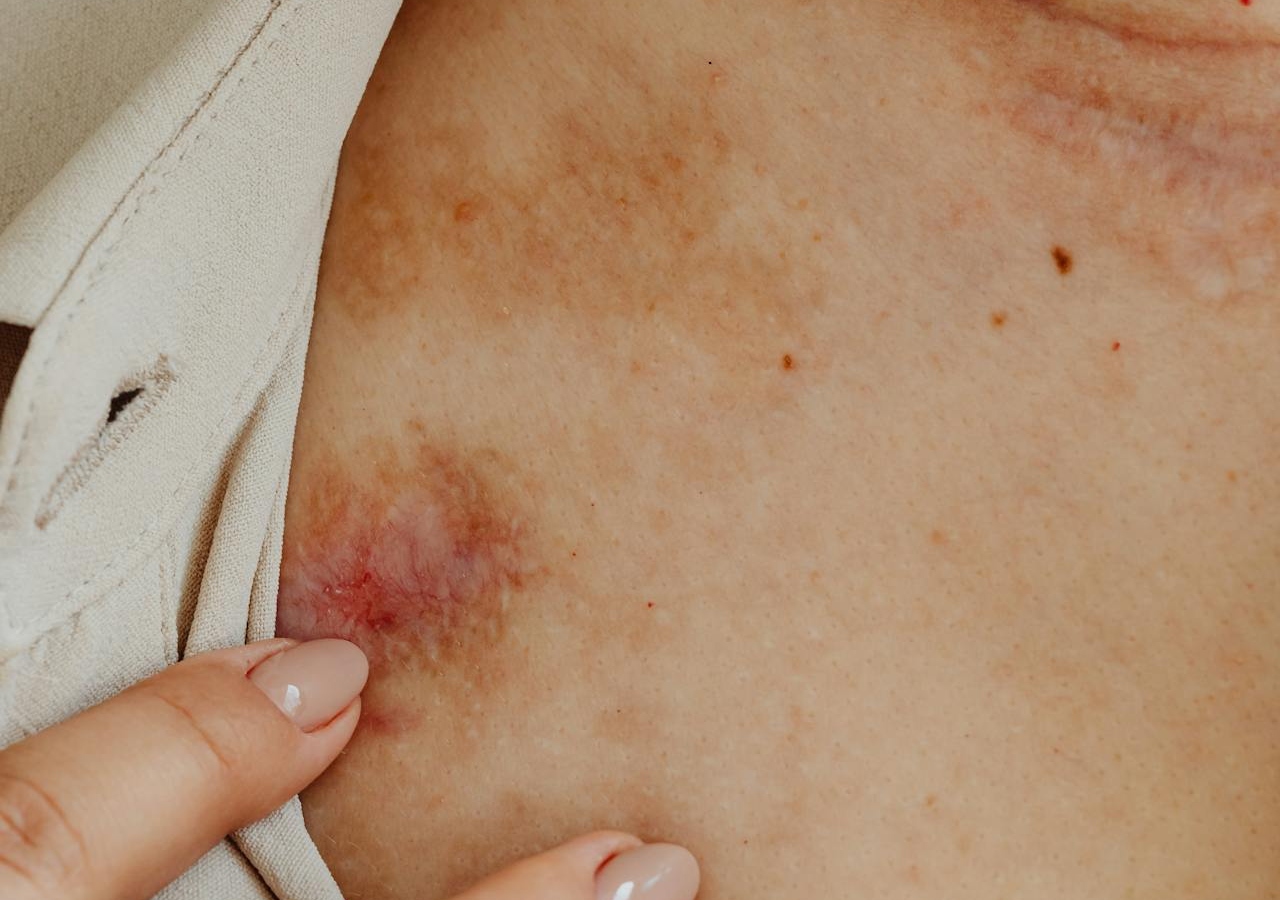 Drugs and Skin Sores: Causes, Symptoms, and Treatments